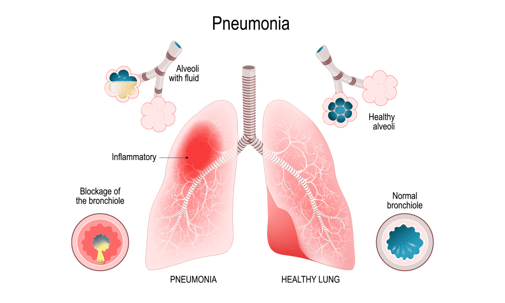 Pneumonia Transmission and its Risk Factors